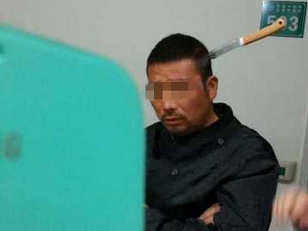 Китаец пришел в больницу с ножом в голове