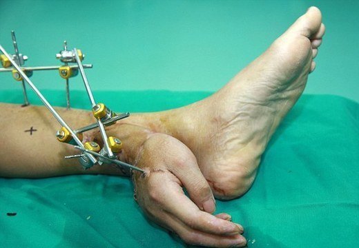 Китайцу пришили отрезанную на работе руку к ноге